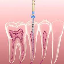 Tại sao cần phải điều trị tủy răng và quy trình thực hiện